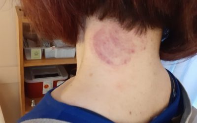 Cupping for neck pain home treatment